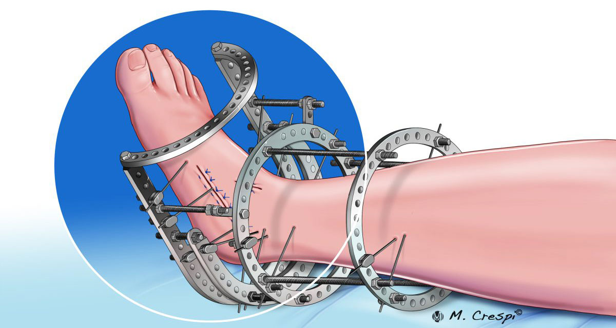 Ankle Fixator External industry insight