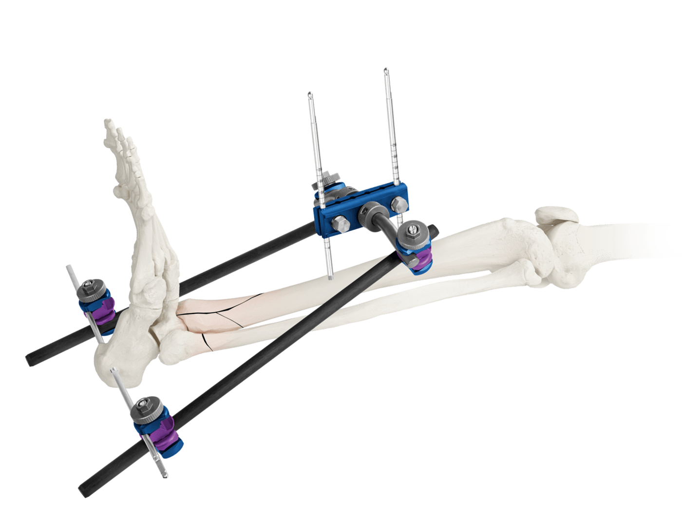 Ankle Fixator External industry insight