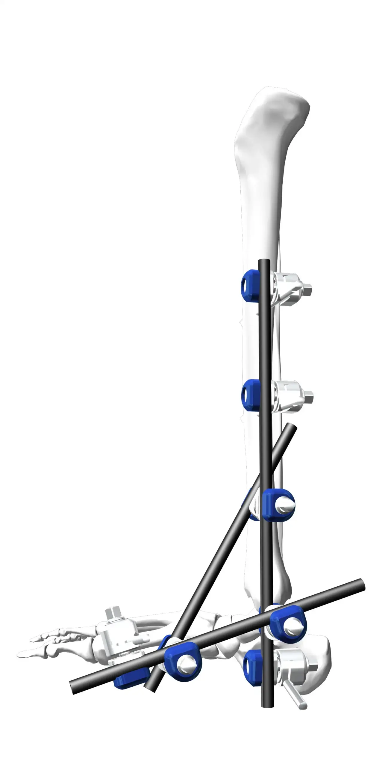 Ankle Fixator External industry insight