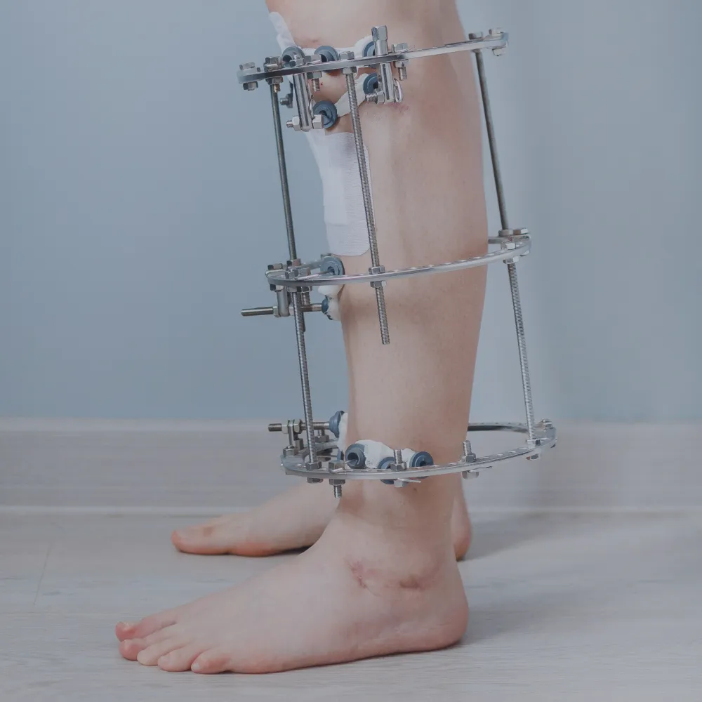 External Fixation