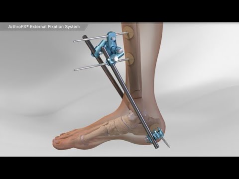 External Fixation System