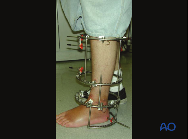 ILIZAROV External Fixator