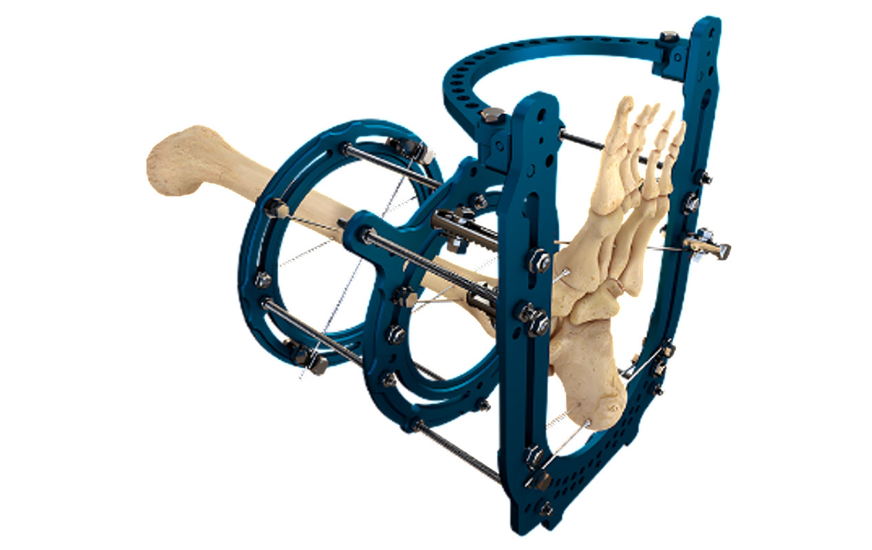 Salvation External Fixation System
